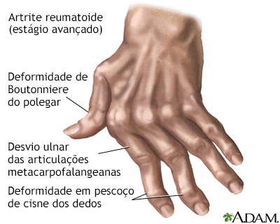 Artrite reumatoide