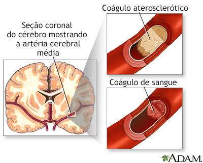 Acidente vascular cerebral