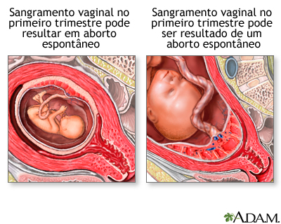 Sangramento vaginal durante a gestação