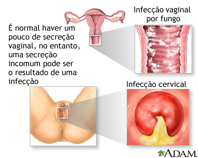 Corrimento vaginal