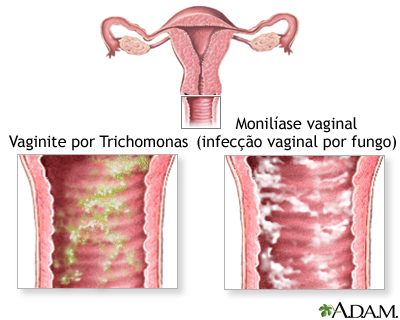 Causas de prurido vaginal