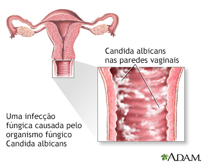 Infecções fúngicas