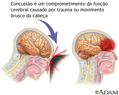 Concussão