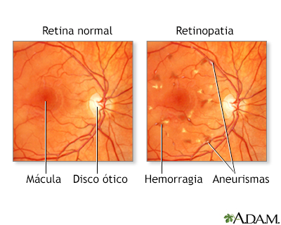 Retinopatia diabética