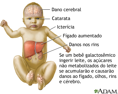 Galactosemia