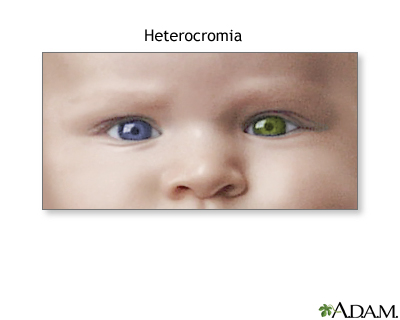 Heterocromia