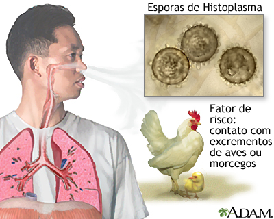 Histoplasmose aguda