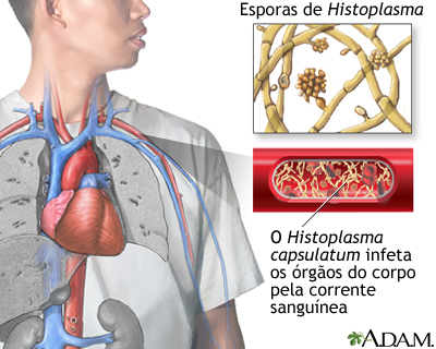 Histoplasmose disseminada