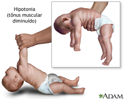 Hipotonia