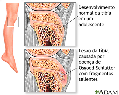 Dor nas pernas (Osgood-Schlatter)