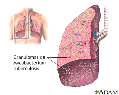 Tuberculose miliar