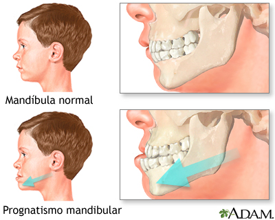 Prognatismo mandibular