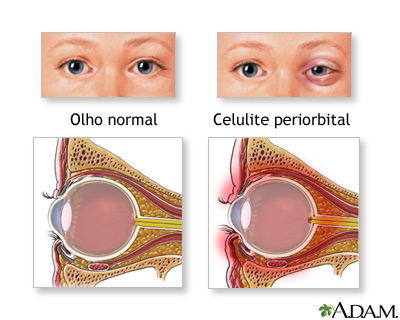 Celulite periorbital