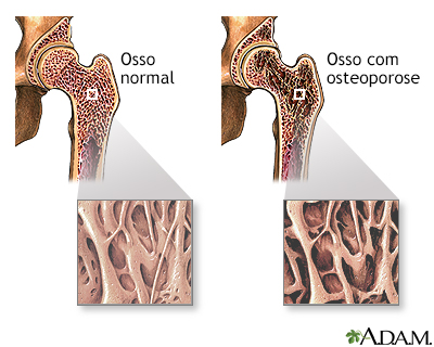 Osteoporose