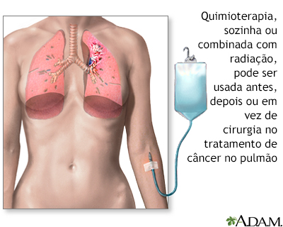 Câncer no pulmão - tratamento com quimioterapia