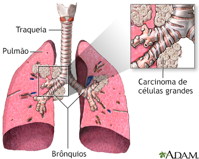 Carcinoma de grandes células