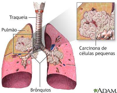 Carcinoma de pequenas células