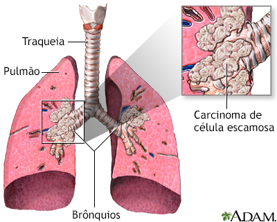 Carcinoma de células escamosas