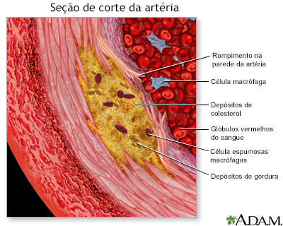 Visualização ampliada da aterosclerose