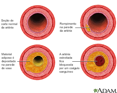 Processo de desenvolvimento de aterosclerose