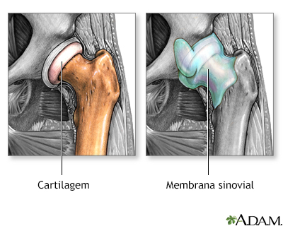 Osteoartrite vs. artrite reumatoide