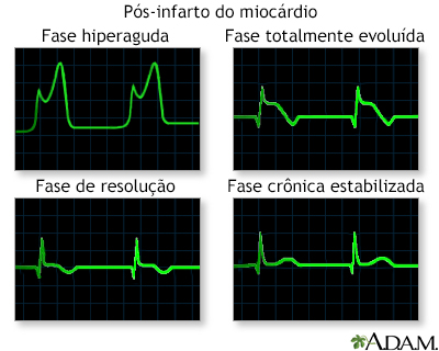 Traçado de ondas de ECG pós-infarto do miocárdio