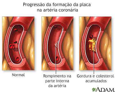 Acúmulo progressivo de placa em artéria coronária