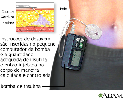 Bomba de insulina