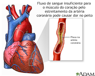 Angina