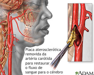 Endarterectomia