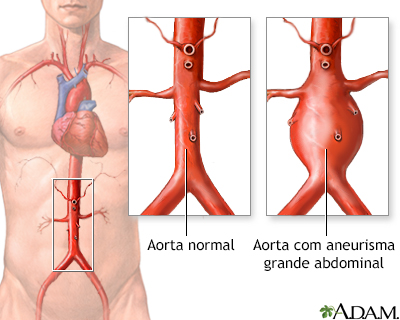 Aneurisma aórtico