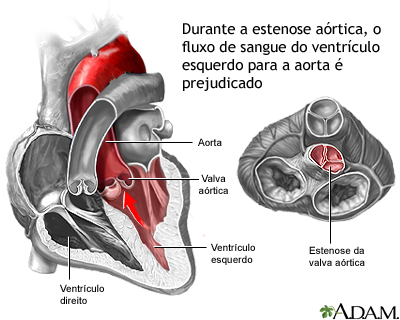 Estenose aórtica