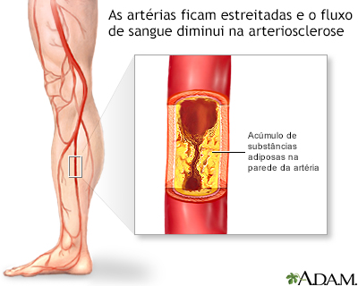 Arteriosclerose das extremidades