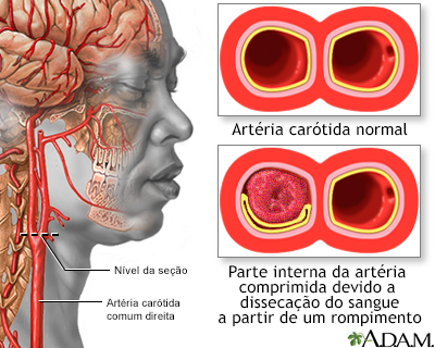 Dissecção da carótida