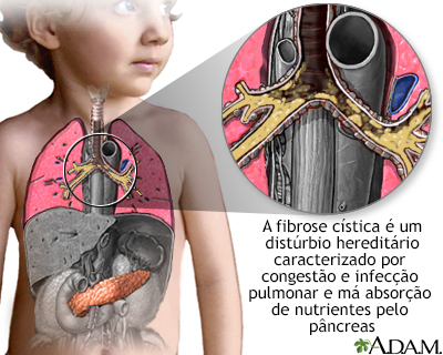 Fibrose cística