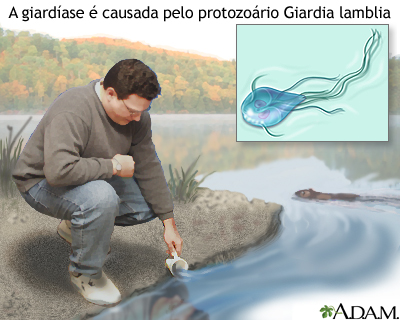 Giardíase