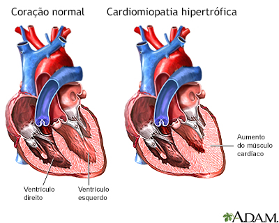 Cardiomiopatia hipertrófica