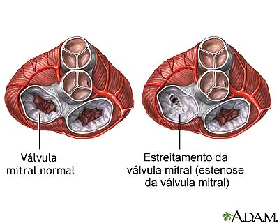 Estenose mitral