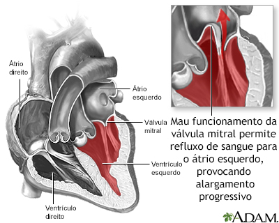 Prolapso da valva mitral