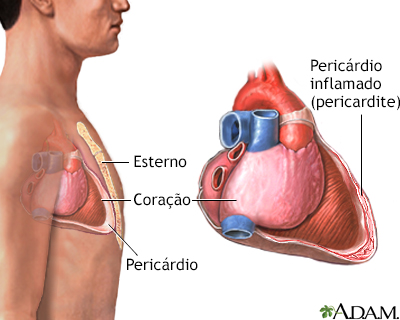 Pericardite