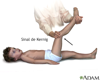 Sinal de Kernig da meningite