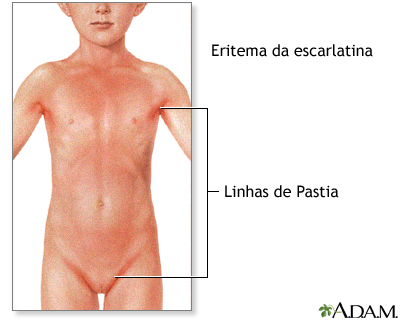 Sinais de escarlatina