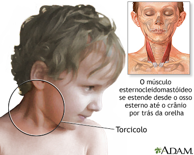 Torcicolo (pescoço duro)