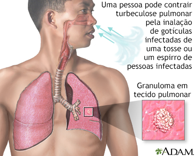 Tuberculose nos pulmões