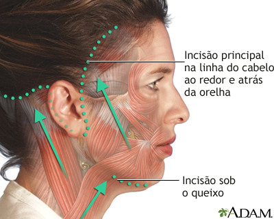 Incisões