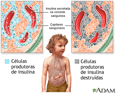 Diabetes tipo 1