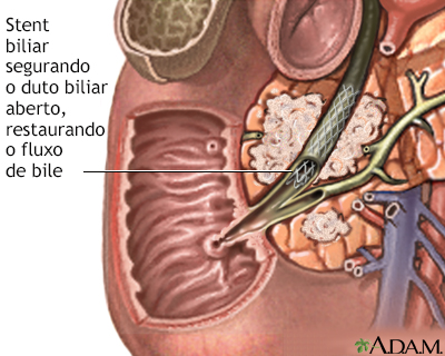 Cuidado após o procedimento