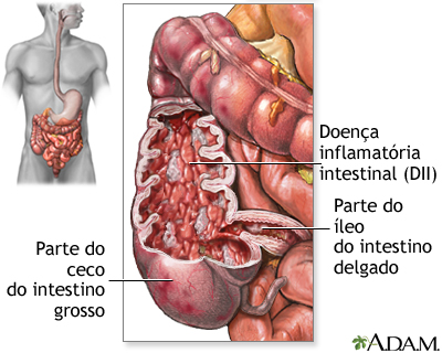 Doença inflamatória intestinal