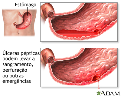 Emergências de úlcera