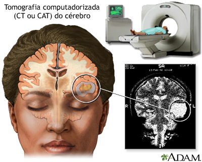 Tomografia computadorizada do cérebro